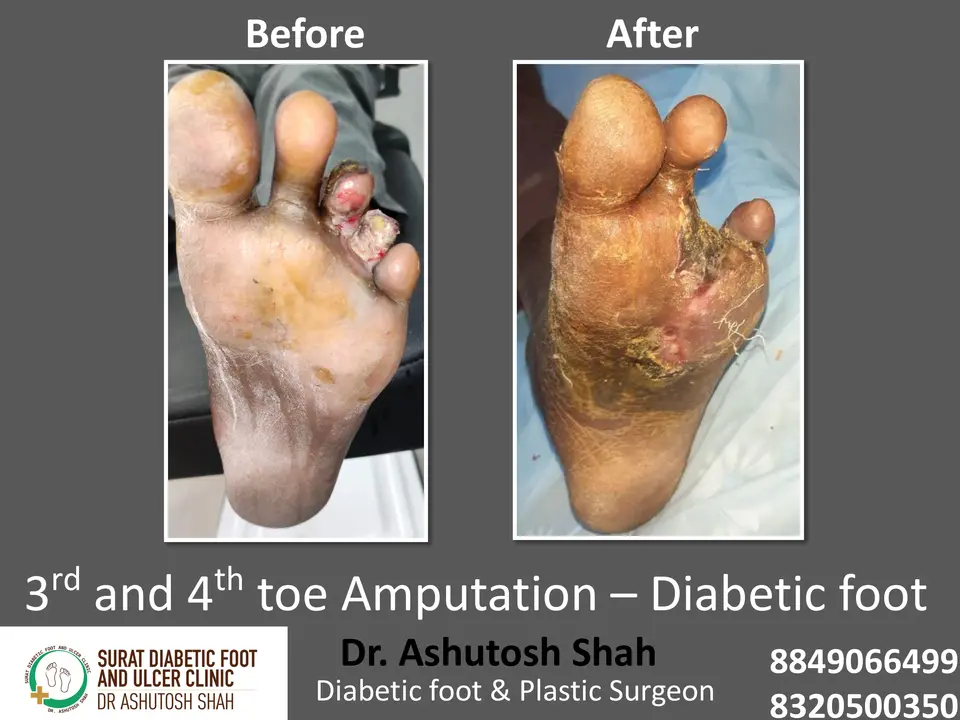 Gangrene and Amputation.pptx-15.webp